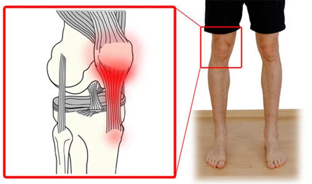 Tendinite – inflammation des tendons de l'articulation du genou