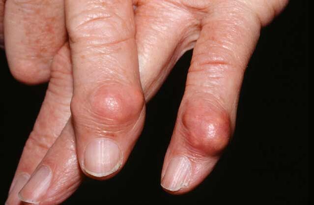 Les compactages des tissus sous-cutanés (tophus) sont un signe de goutte.