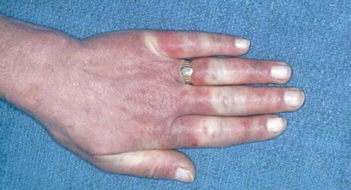 Tableau clinique du syndrome de Raynaud - vasospasme, hyperémie, œdème